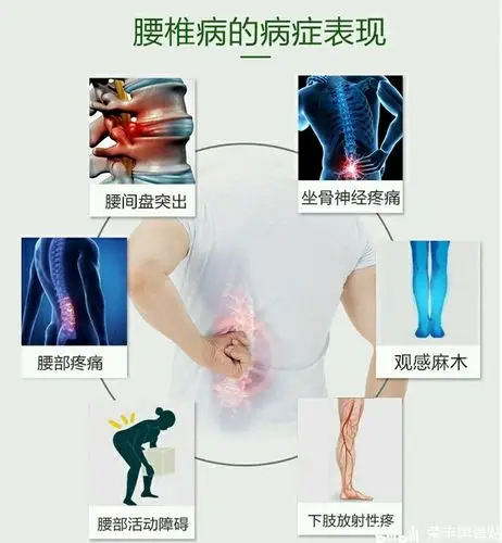 腰椎间盘突出症,为什么症状都集中在腿部?