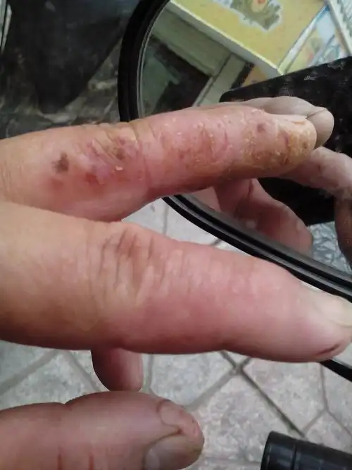 请问手指皮肤起水泡红肿,患处皮肤干操厚实起口子怎样用药,己经四年多