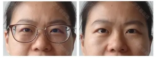 戴近视眼镜后,真的会「变丑」?眼科医生坐不住了