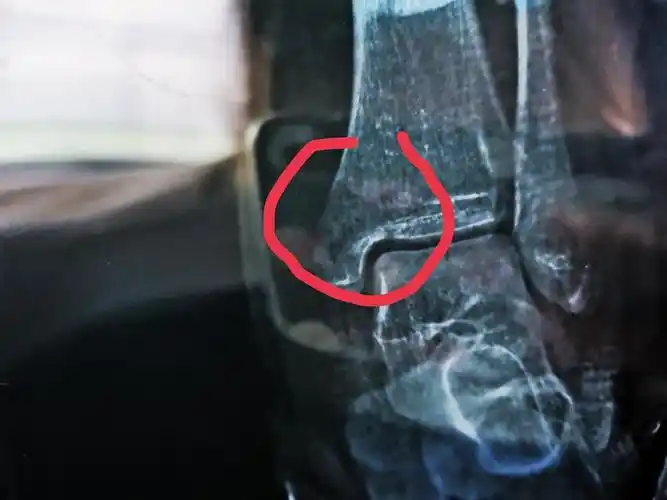 右脚内踝骨折,有uu帮忙看看这个伤的严重吗