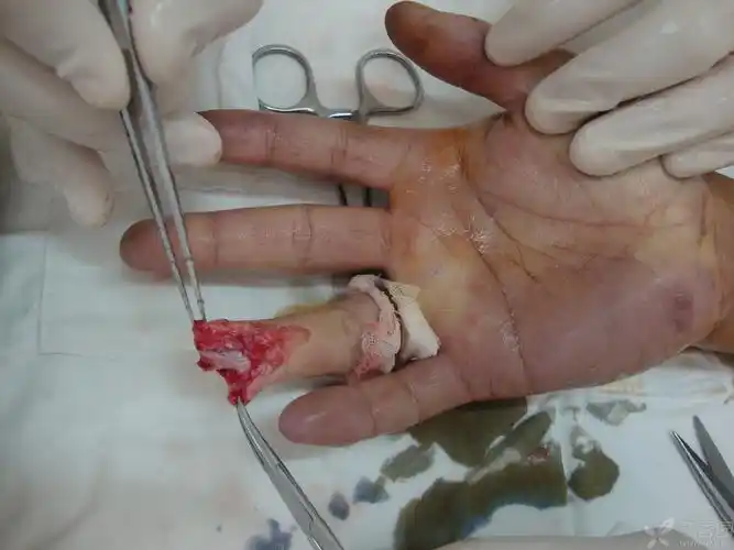 【讨论】手指全形再造请教 - 修复重建和烧伤整形讨论版 -丁香园论坛