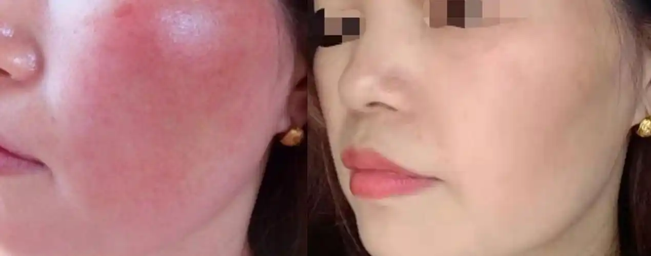 干货如何彻底摆脱易过敏反复红肿瘙痒的敏感肌分享我15天成功对抗敏感