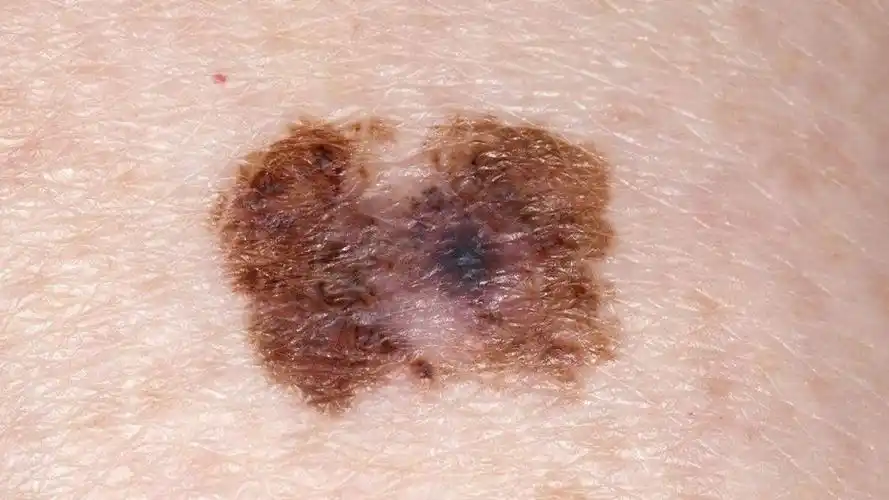 皮肤上的黑斑突然扩大要当心,可能是皮肤癌的表现