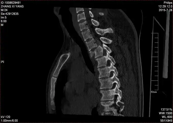 受伤后被家人送入大石桥骨科医院,行胸椎三维ct检查示:,胸腰椎骨折