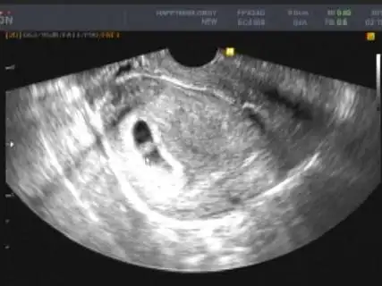 怀孕6周孕囊有多大