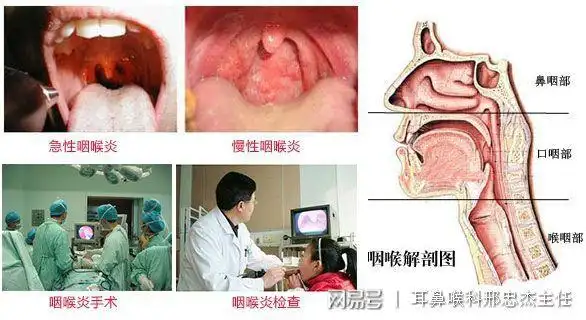 慢性咽炎很顽固千万不要大意