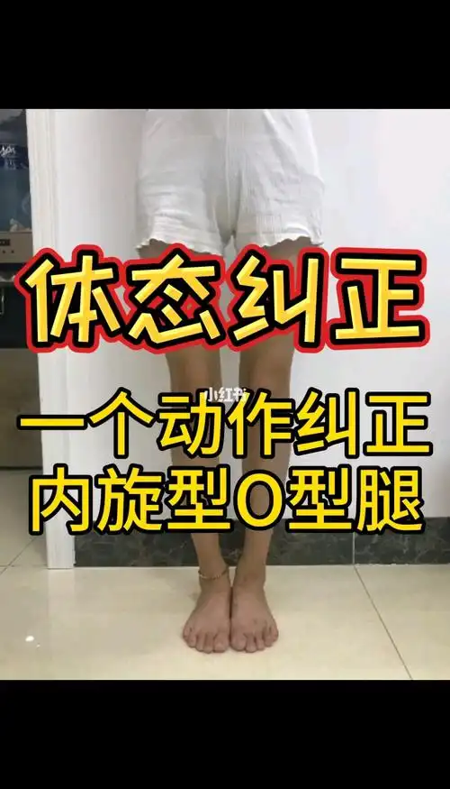 体态矫正一个动作纠正内旋型o型腿