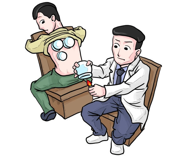【中医养生】这些关于拔罐的知识,您应该知道