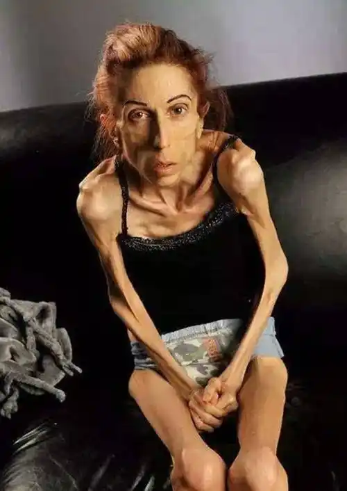 世界上最瘦的女人:从开朗自信到堪称行走的骷髅_减肥_身体_身材