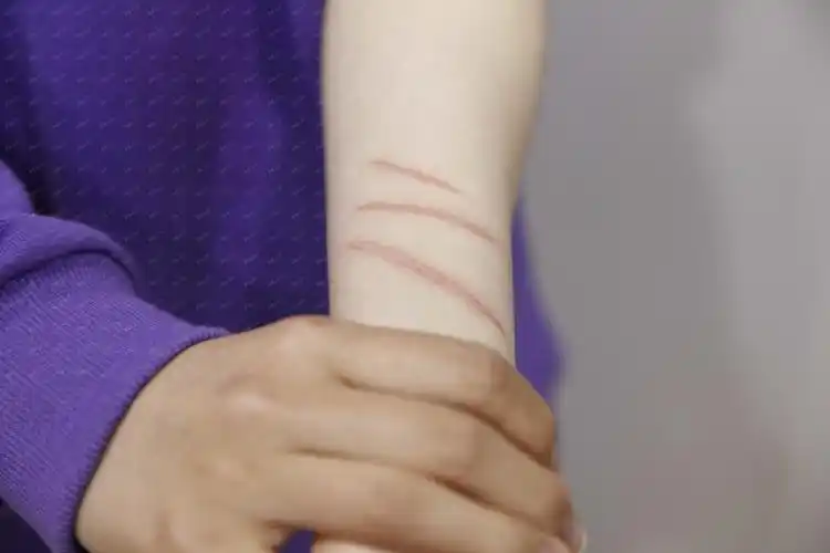 上的疤手上伤疤图片手上刀疤图片手上的伤疤真人图片痞幼手上的疤疤痕