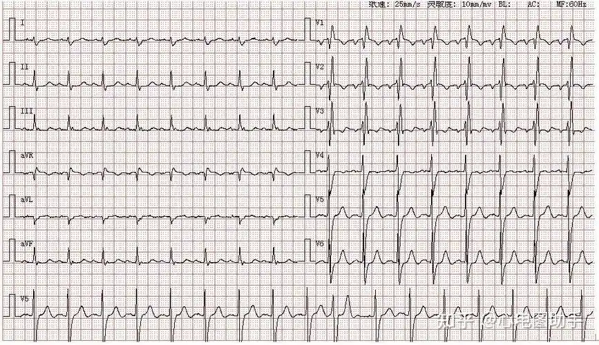 心电图图谱丨二尖瓣型p波左心房异常
