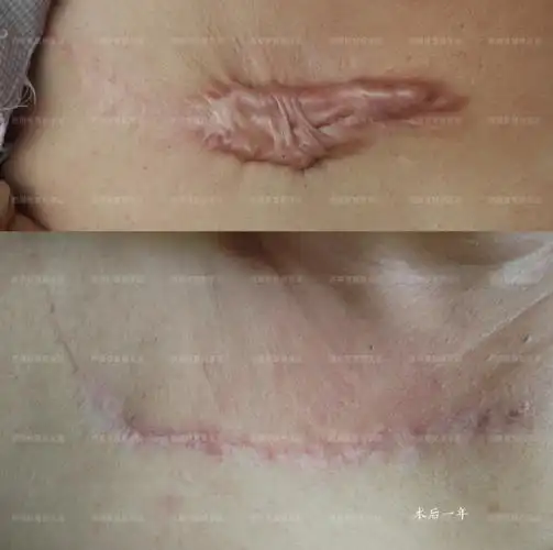 疤痕##疤痕疙瘩