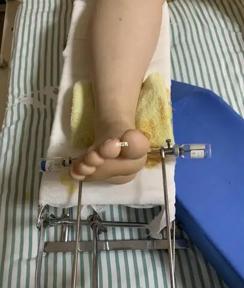 终于上了让我最恐惧的"刑具"——牵引器.