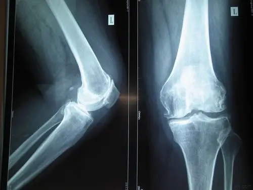 帮忙看看这张片子 - 骨科与显微外科专业讨论版 - 爱爱医医学论坛