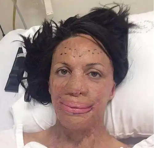 让医生没想到的是,在经历了200多次的手术后,turia成功活了下来.