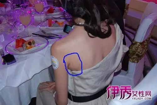 孙菲菲出席某时尚活动 背部惊现明显红痕(组图)