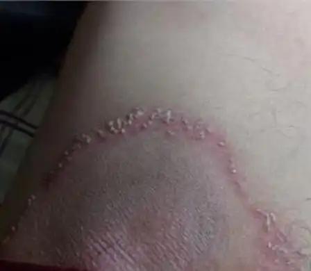 股癣的症状表现是什么