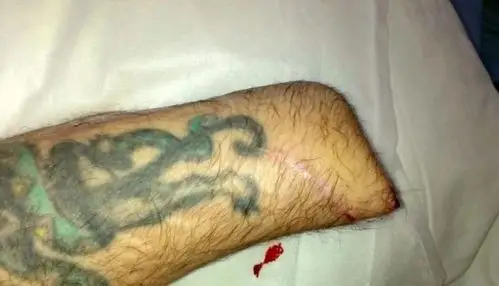 英男子车祸后神经受损痛疼难忍自行截肢