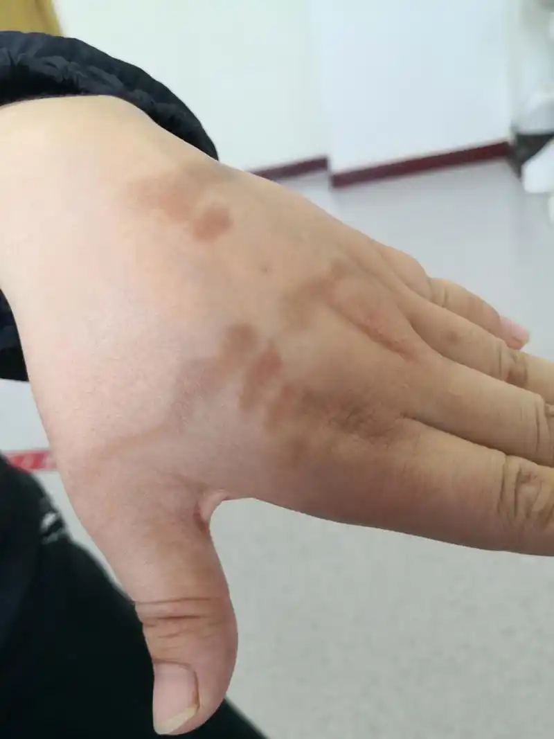 解决皮肤问题专注皮肤美容##色素沉着# 排查一下萎缩纹#美容