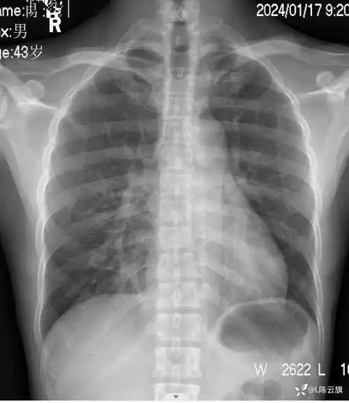 每周胸片214正位胸片有问题吗