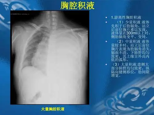 游离性胸腔积液 (1)少量积液 液体 先积于后肋膈角,站立 后前位胸片