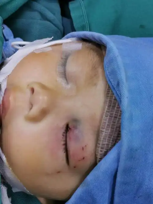 1岁宝宝被狗咬伤眼睛的求医之路:一波七折,从绝望到希望新浪重庆 2020