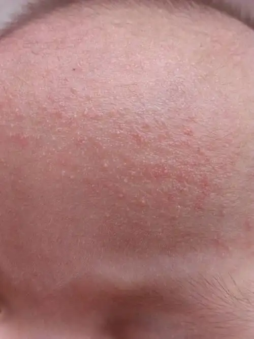 主治医师来自淳化县中医医院 答: 这种情况多见于热痱子或是湿疹,没有