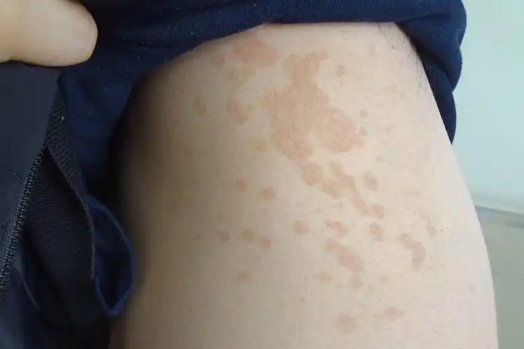 淡褐色皮损图