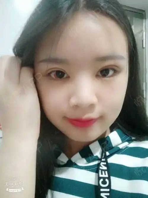 全切双眼皮术后10天_眼综合术后10天_开眼角术后10天_双眼皮术后10天