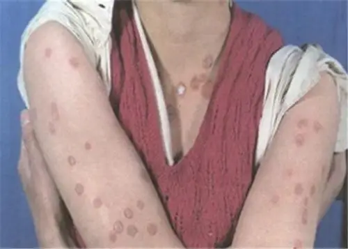 花斑癣手臂很严重的症状图片