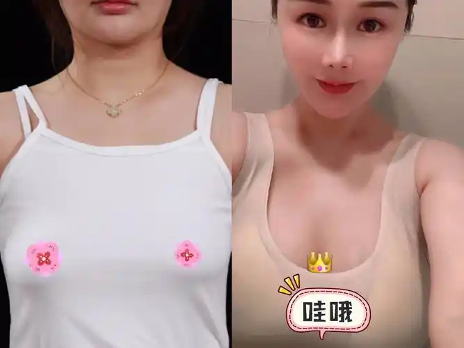 求美者生产哺乳后,胸部特别松垂,胸部形态不佳,导致_圈子-新氧美容