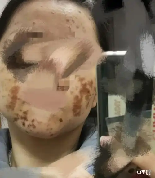 果酸灼伤是什么体验?