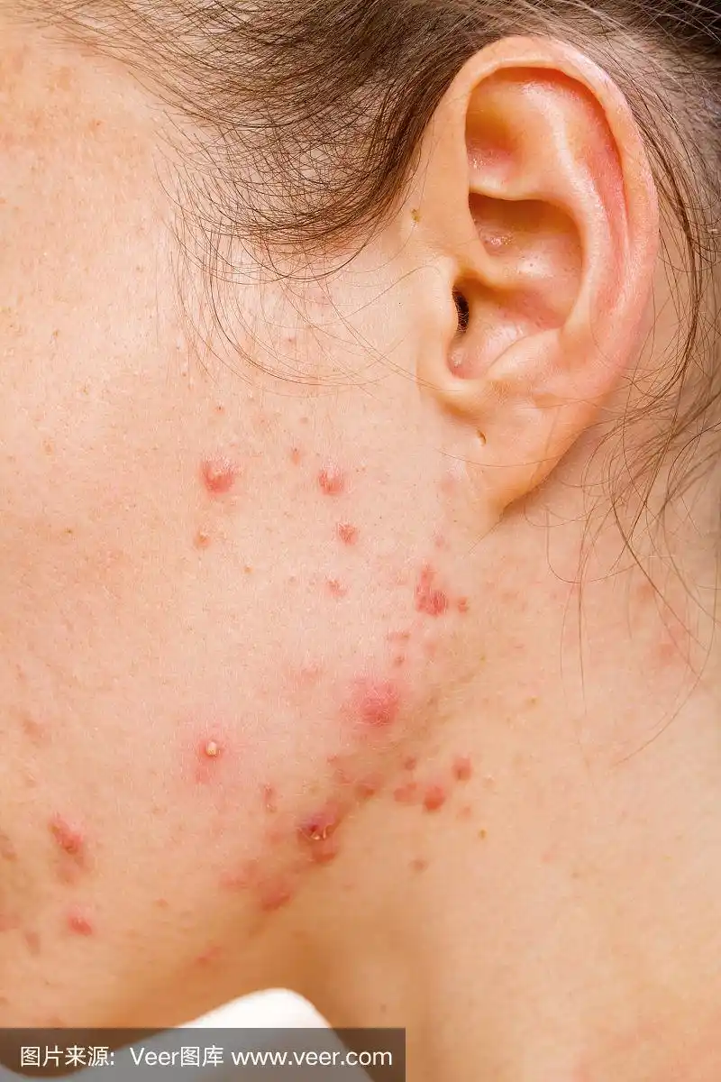 痤疮皮肤