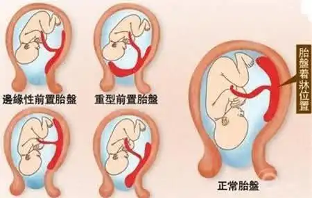 胎盘几个月位置才固定产科专家给出答案准妈妈可要注意了
