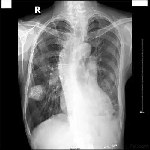 肺结核的胸片检查特点_新浪山西健康医师呼吸系统重要考点总结:第八