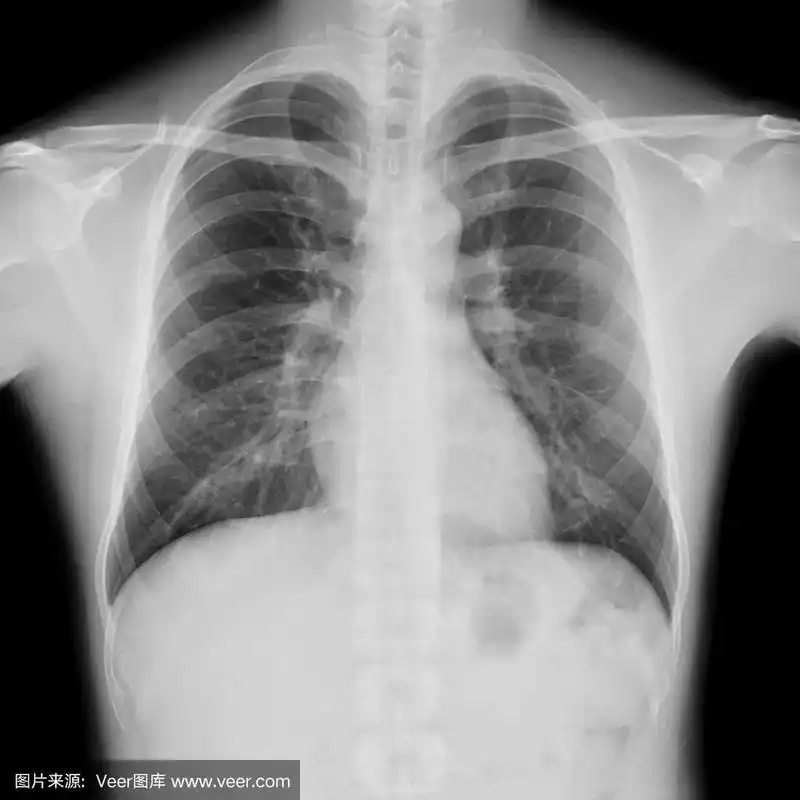 正常男性胸部x线片