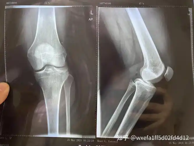 胫骨平台骨折塌陷保守治疗