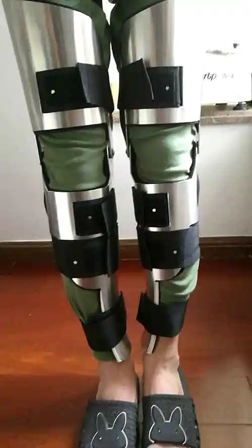 中青年男性o型腿矫正案例