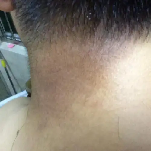 背后的黑色东西持续了两个月了一直有不知道是不是病.