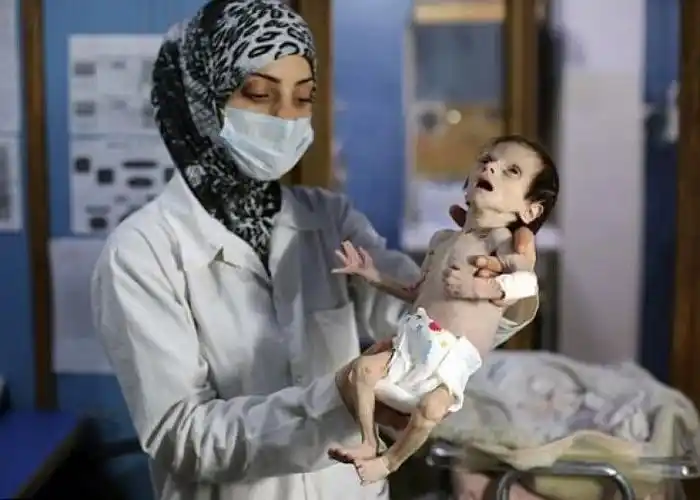 心酸!叙利亚一儿童因战祸而瘦骨嶙峋,双眼暴凸(图)