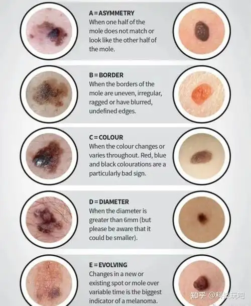 痣也会引起癌变,这几种痣要警惕!