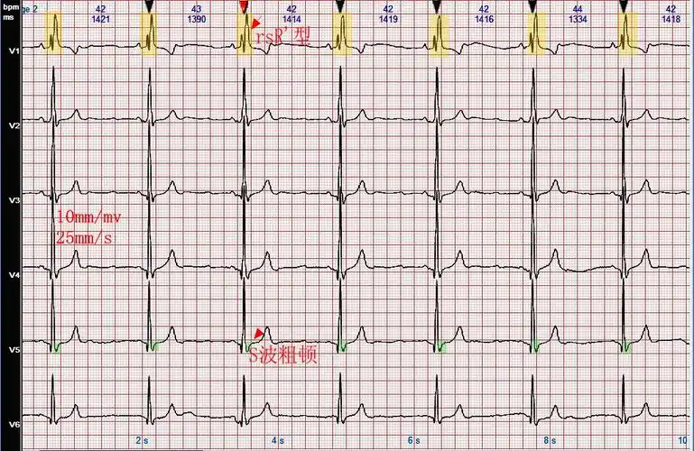 心电图病例分析完全性右束支阻滞