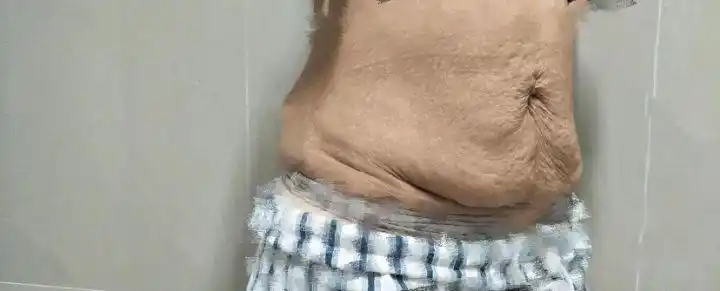 产后腹部严重松弛下垂关于腹壁成型术这些你都要了解