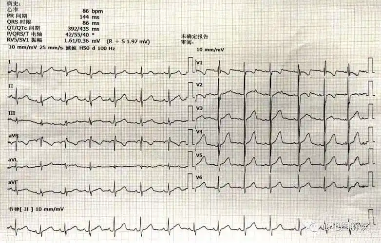 不完全性右束支阻滞