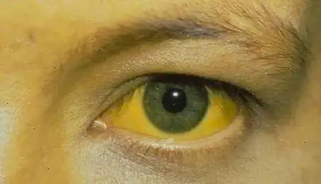 眼睛,皮肤发黄发黑