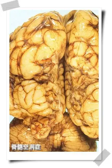 脊髓空洞症 - 如意门诊