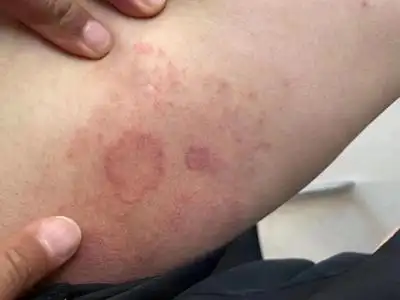 股癣的症状和图片 - 有来医生