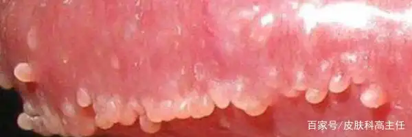 珍珠状丘疹和尖锐湿疣的区别