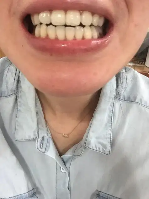 为什么我觉得牙齿越排越歪了有图