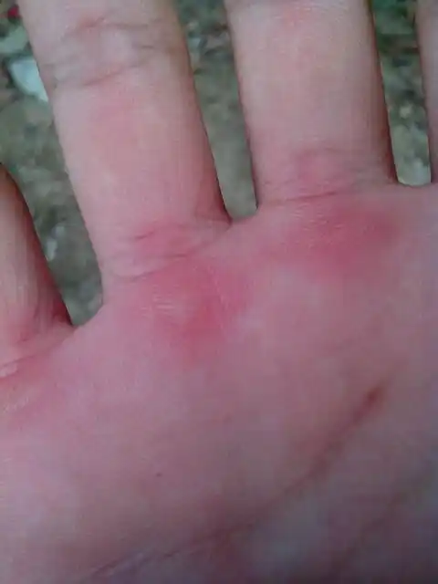 干活时手上磨起的水泡,你知道怎么形成的吗?